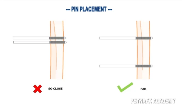 Schanz pins are type of orthopedic pin used in external fixation to stabilize bone fractures. 