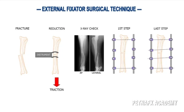 Schanz pins are type of orthopedic pin used in external fixation to stabilize bone fractures. 