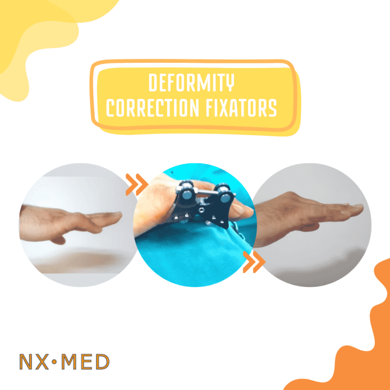 NX-MED Deformity Correction Fixators